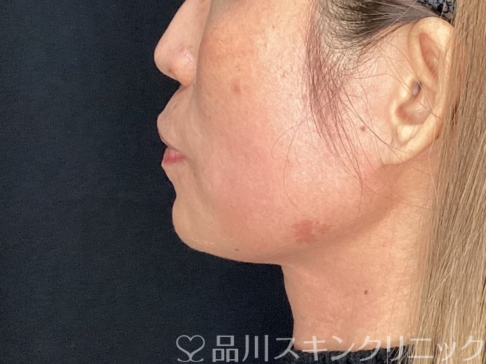 症例NO.72661のAFTER写真