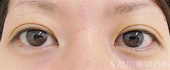 症例NO.29072のAFTER写真