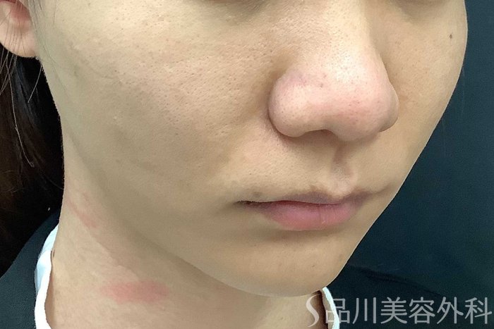 症例NO.63006のAFTER写真