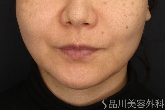 症例NO.71566のBEFORE写真