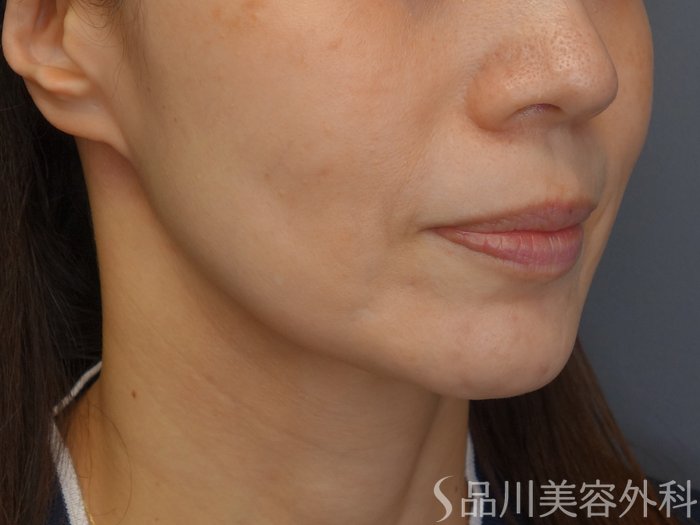 症例NO.67848のBEFORE写真