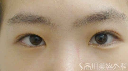 症例NO.62301のAFTER写真