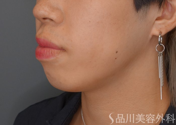 症例NO.75358のBEFORE写真