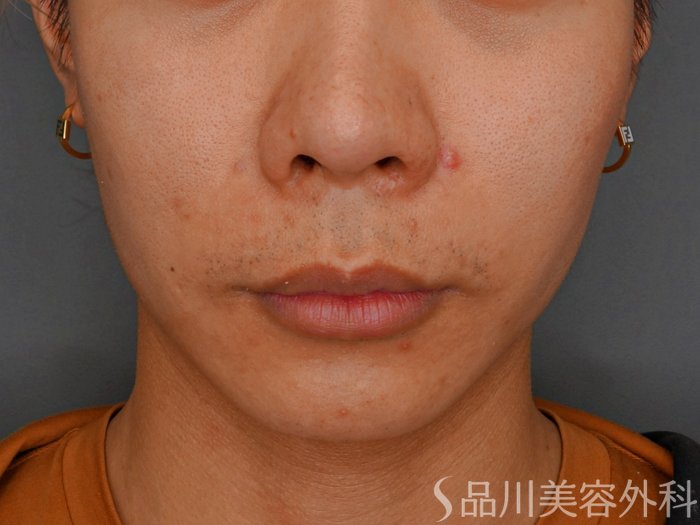 症例NO.73755のBEFORE写真