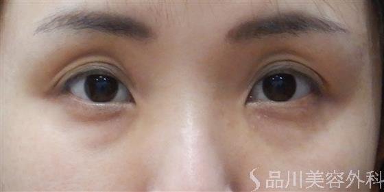 症例NO.59630のBEFORE写真