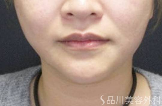 症例NO.72724のAFTER写真