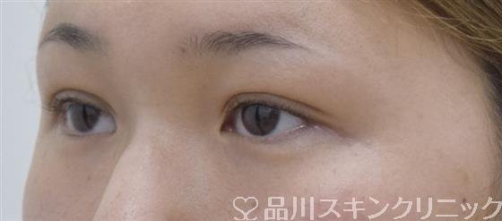 症例NO.53629のAFTER写真