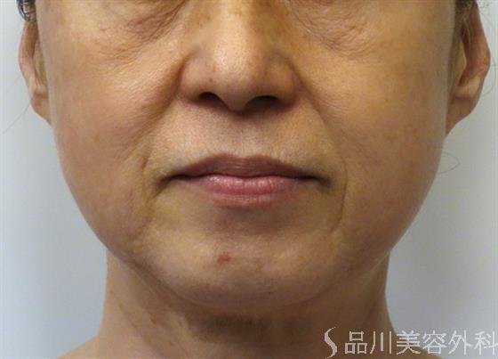 症例NO.43378のBEFORE写真