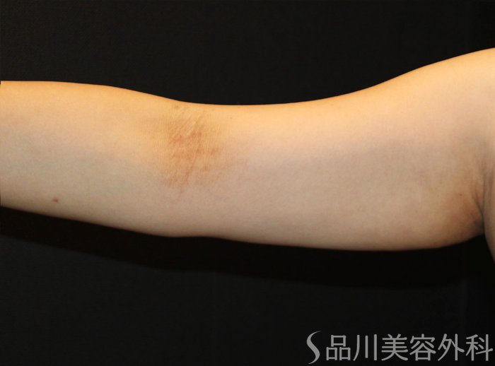 症例NO.73741のBEFORE写真