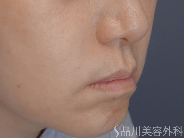 症例NO.72391のAFTER写真