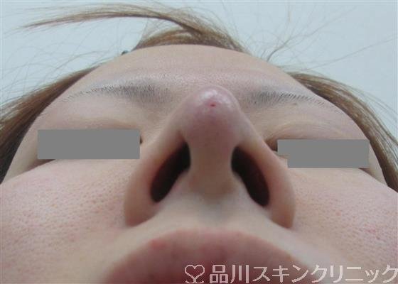 症例NO.32394のAFTER写真