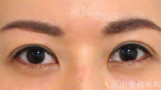 症例NO.27001のAFTER写真
