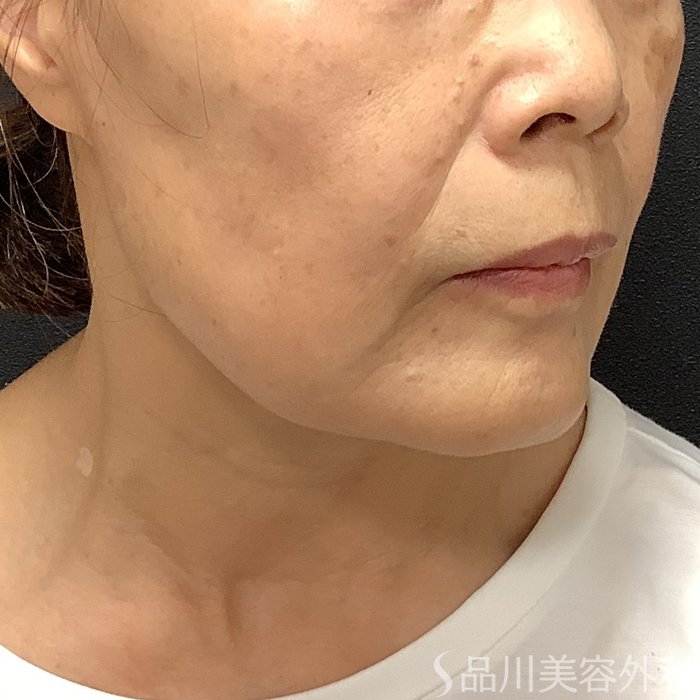 症例NO.75395のBEFORE写真