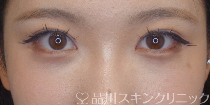 症例NO.74555のBEFORE写真