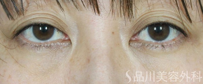 症例NO.69274のBEFORE写真