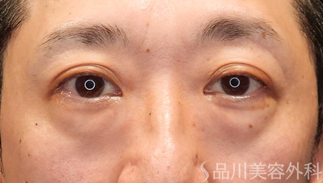 症例NO.75058のBEFORE写真