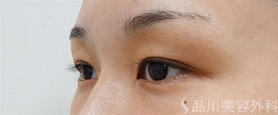 症例NO.53383のBEFORE写真