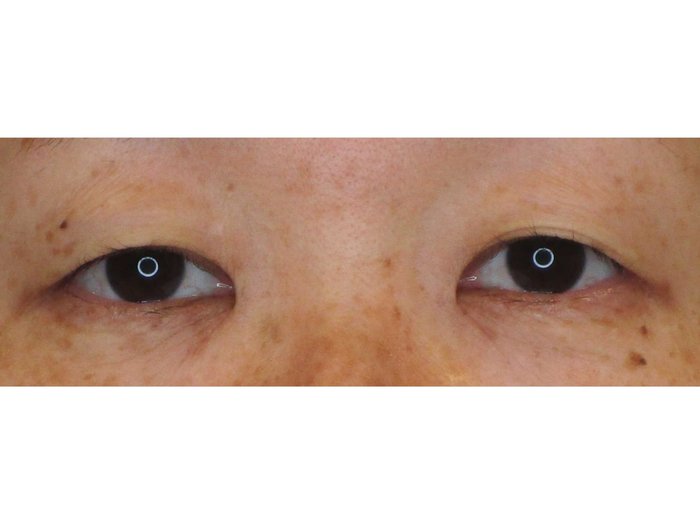 症例NO.74682のBEFORE写真