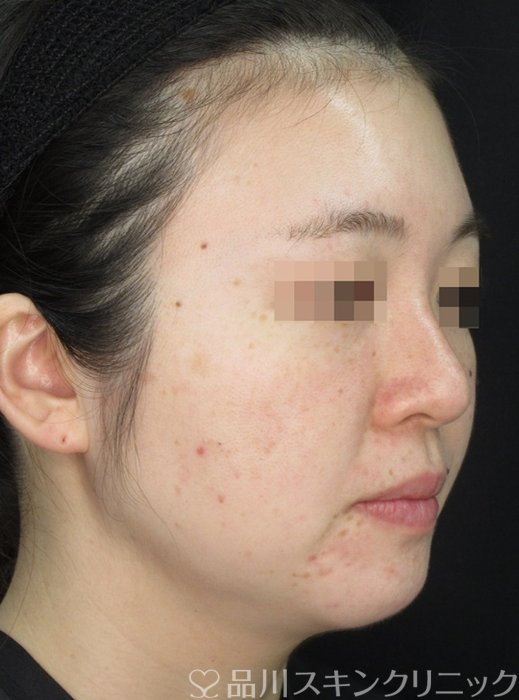 症例NO.72175のBEFORE写真