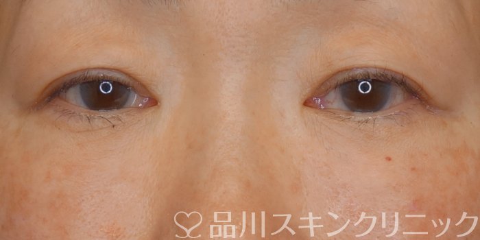 症例NO.72559のAFTER写真