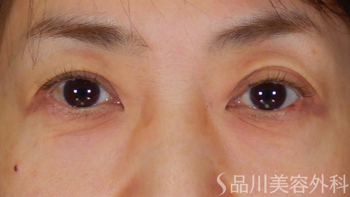 症例NO.69814のBEFORE写真