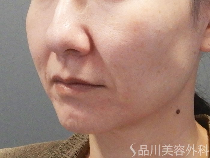 症例NO.73937のBEFORE写真