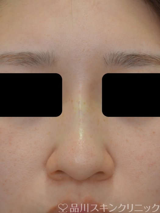 症例NO.73577のAFTER写真