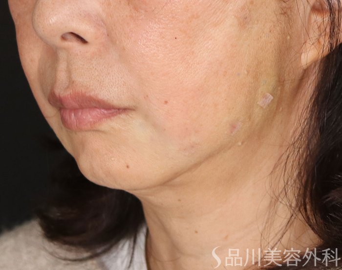 症例NO.72729のAFTER写真