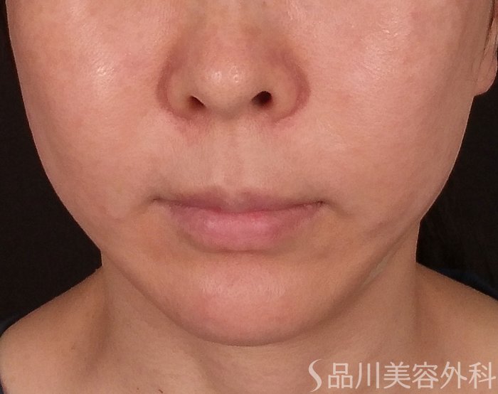 症例NO.70212のAFTER写真