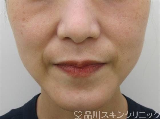 症例NO.52740のBEFORE写真