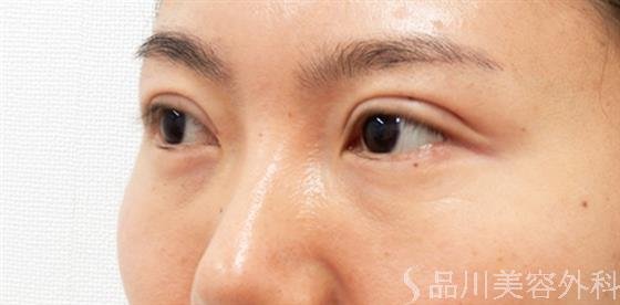 症例NO.53420のAFTER写真