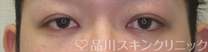 症例NO.74410のAFTER写真