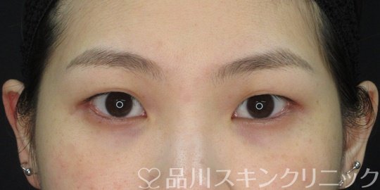 症例NO.72209のBEFORE写真