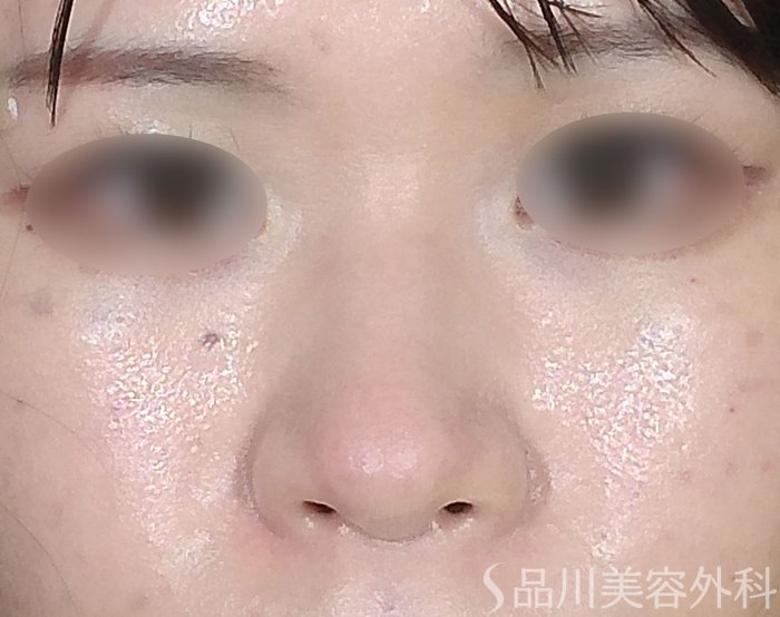 症例NO.68337のAFTER写真