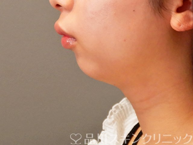 症例NO.70815のBEFORE写真