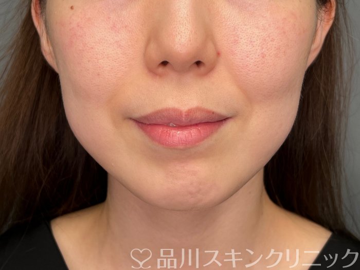 症例NO.64894のBEFORE写真