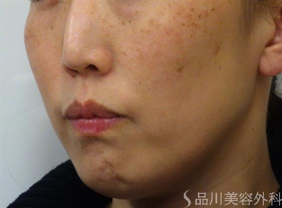 症例NO.41206のBEFORE写真