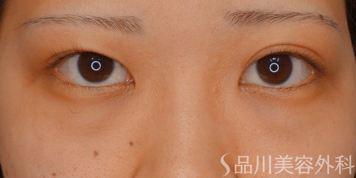 症例NO.73264のBEFORE写真