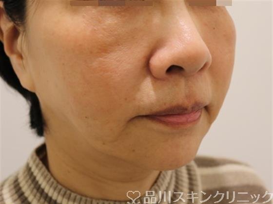 症例NO.41707のBEFORE写真