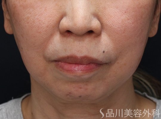 症例NO.74635のBEFORE写真