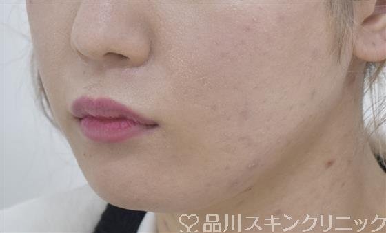 症例NO.53434のBEFORE写真