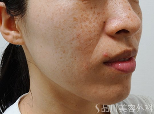 症例NO.75186のBEFORE写真