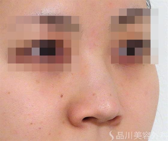 症例NO.36512のBEFORE写真