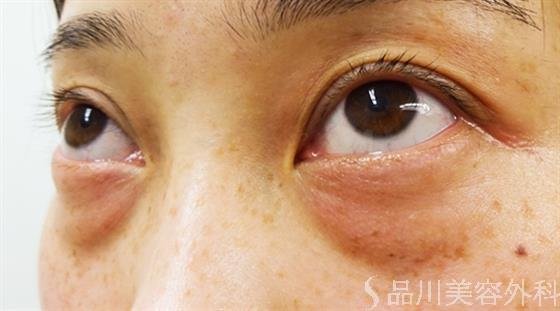 症例NO.31951のBEFORE写真