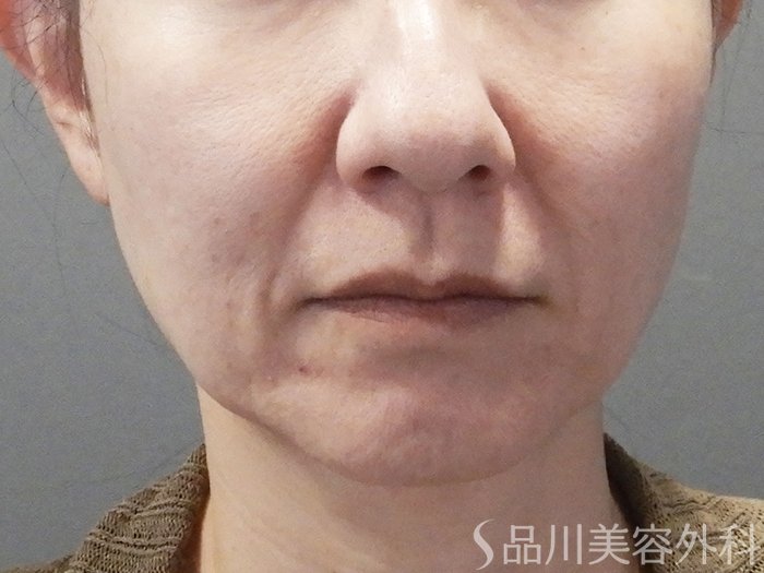 症例NO.72103のBEFORE写真