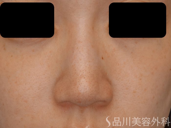 症例NO.71204のBEFORE写真