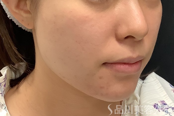 症例NO.71000のBEFORE写真