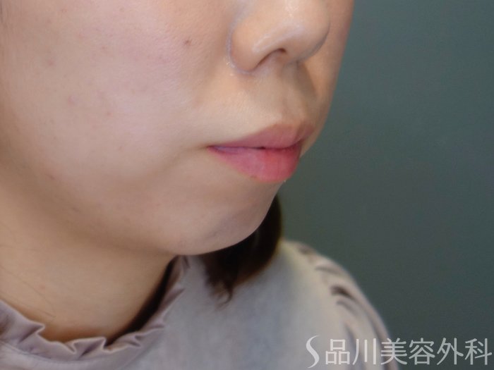 症例NO.69506のBEFORE写真