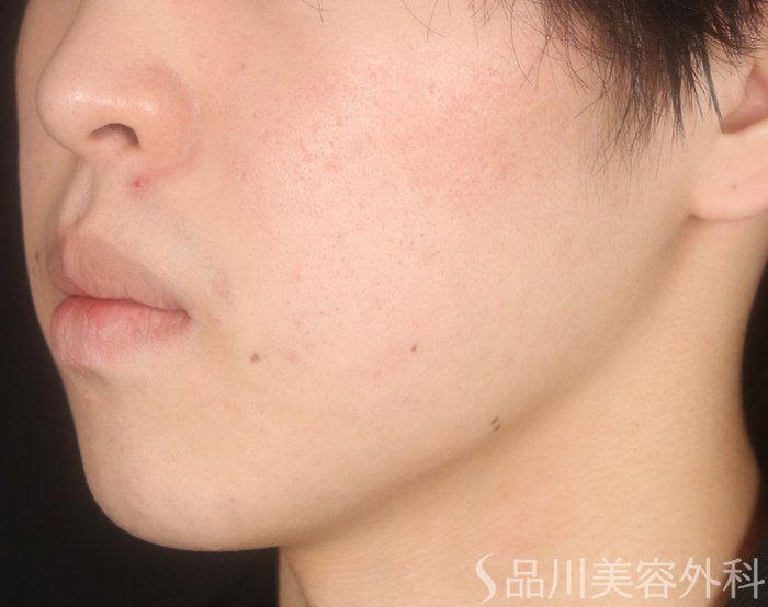 症例NO.73066のAFTER写真