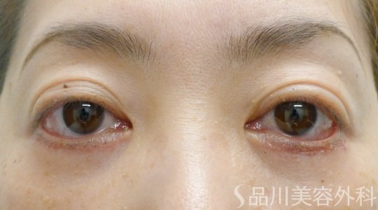 症例NO.62285のAFTER写真